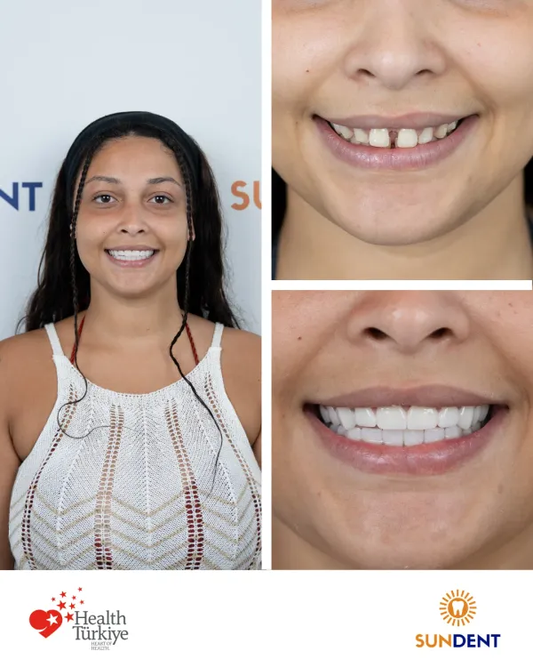Before and After Treatment 1
