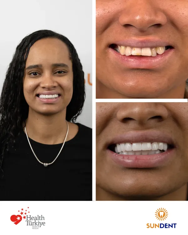 Before and After Treatment 10