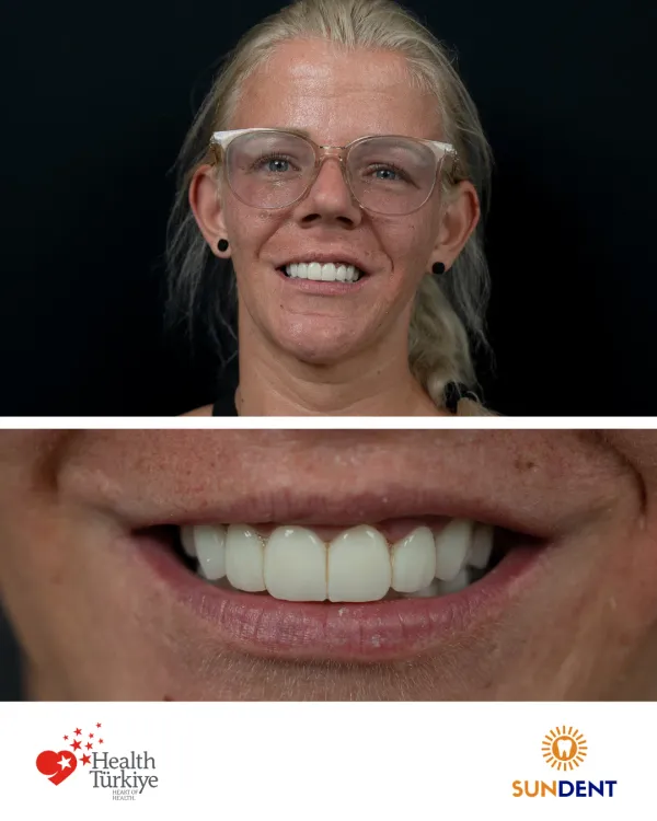Before and After Treatment 18