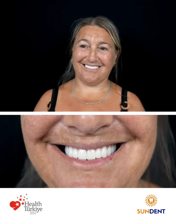Before and After Treatment 20