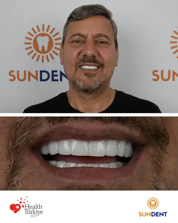Before and After Treatment 21