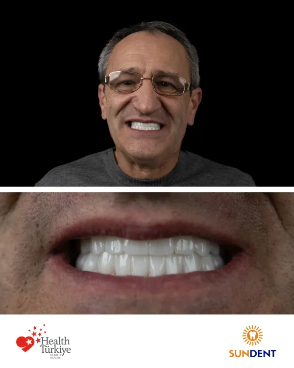 Before and After Treatment 22
