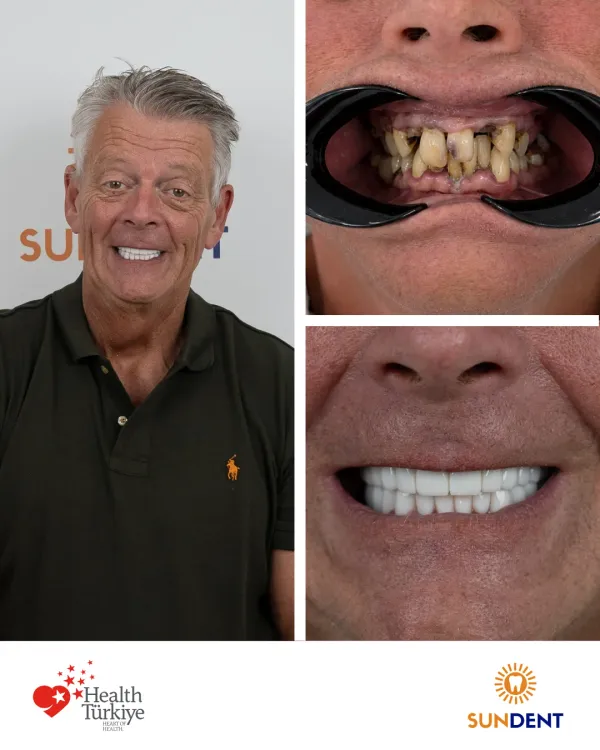 Before and After Treatment 5